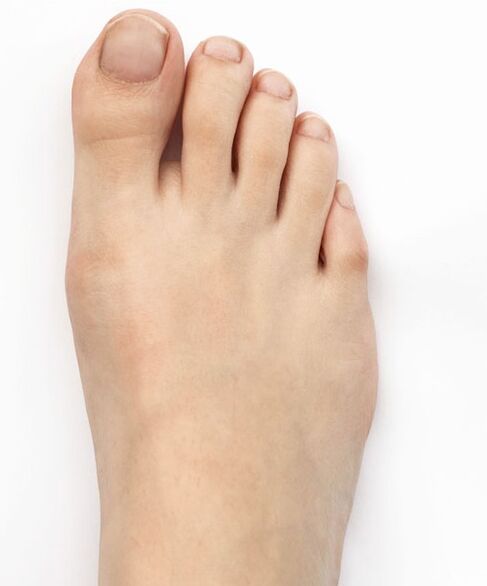Başparmak valgusumu Hondro Sol Valgus sprey ile iyileştirdim