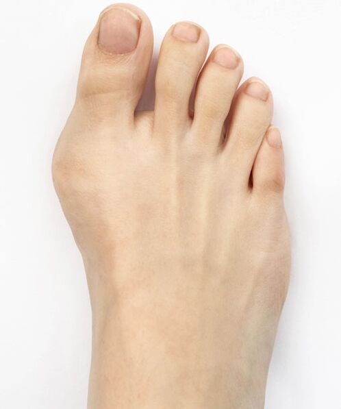 Hondro Sol Valgus spreyi kullanmadan önce halluks valgus