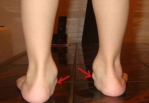 Çocuklarda ayakların valgus deformasyonu