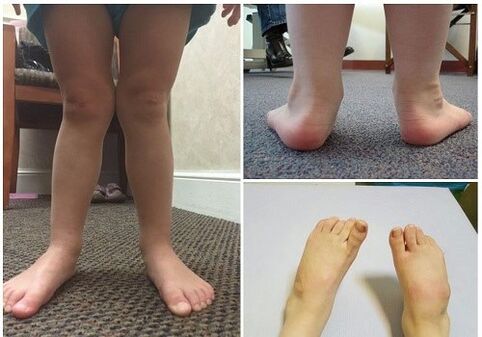 Çocuklarda Valgus deformasyonu